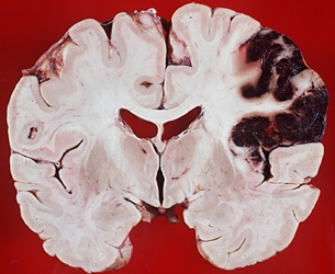 imagini infarctul cerebral